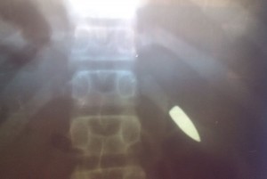 Côte d'Ivoire: Mutinerie, ces innocents blessés par balles, qui les prend en charge ?