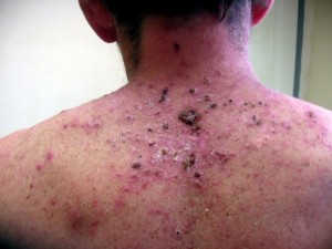 Madagacar:  La peste sème la terreur, le bilan monte à  30 morts