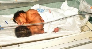 Côte d'Ivoire: Les siamoises nées au CHR de Man évacuées au CHU de Yopougon, leur pronostic vital n'est pas engagé, selon les médecins